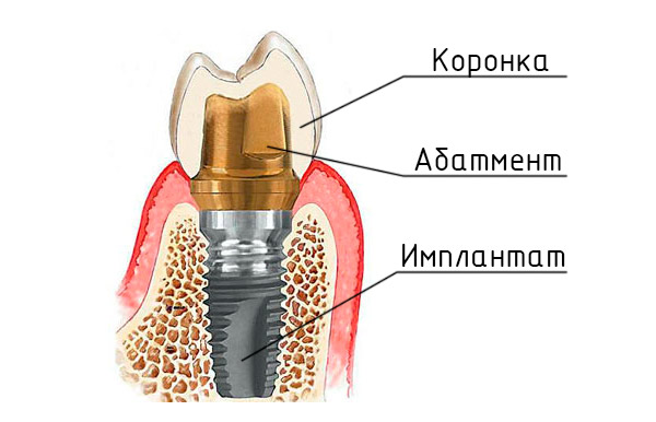 Зубной имплантат Nobel Biocare из чистого медицинского титана класса 4(G4Ti)